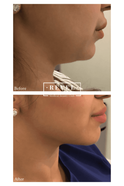 Revel Medical Beauty Club offers chin fat slimming treatments.