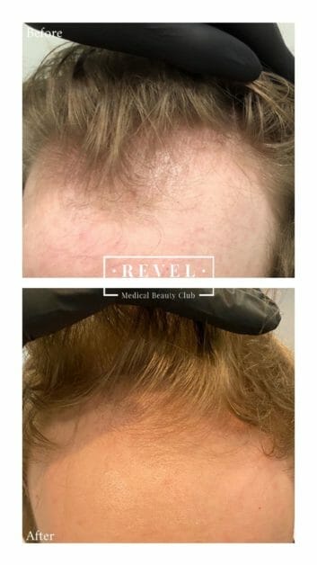 Platelet Rich Plasma Therapy can rejuvenate hair growth.