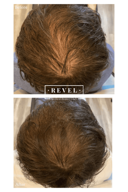 Platelet Rich Plasma Therapy can restore lost or thinning hair.