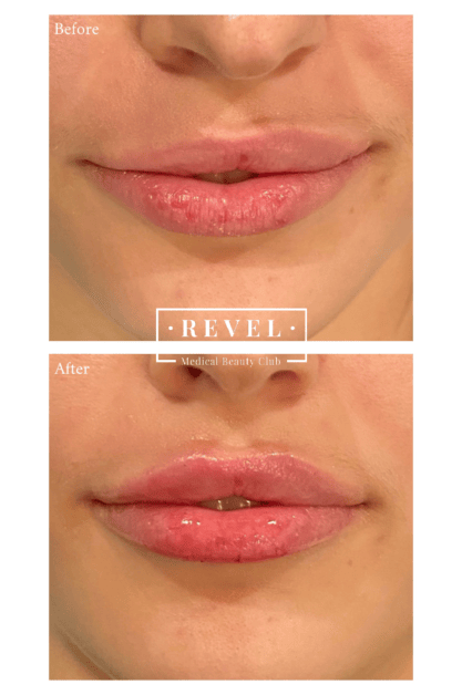 Get plump and even lips with our lip enhancement treatments.