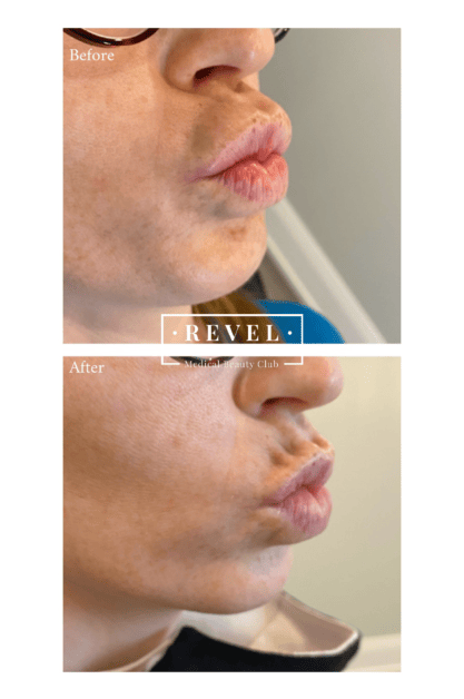 Lip enhancement can correct imperfections.