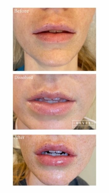 Lip enhancement can give you the full smile you've always wanted.