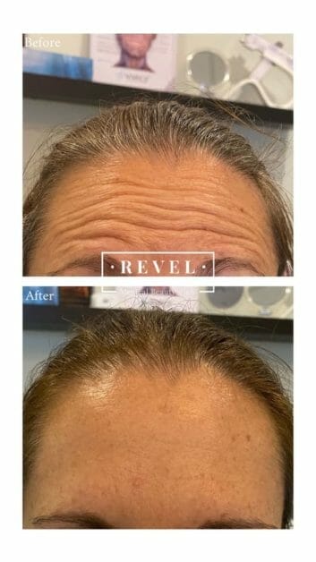 Ask about our forehead wrinkle treatments.