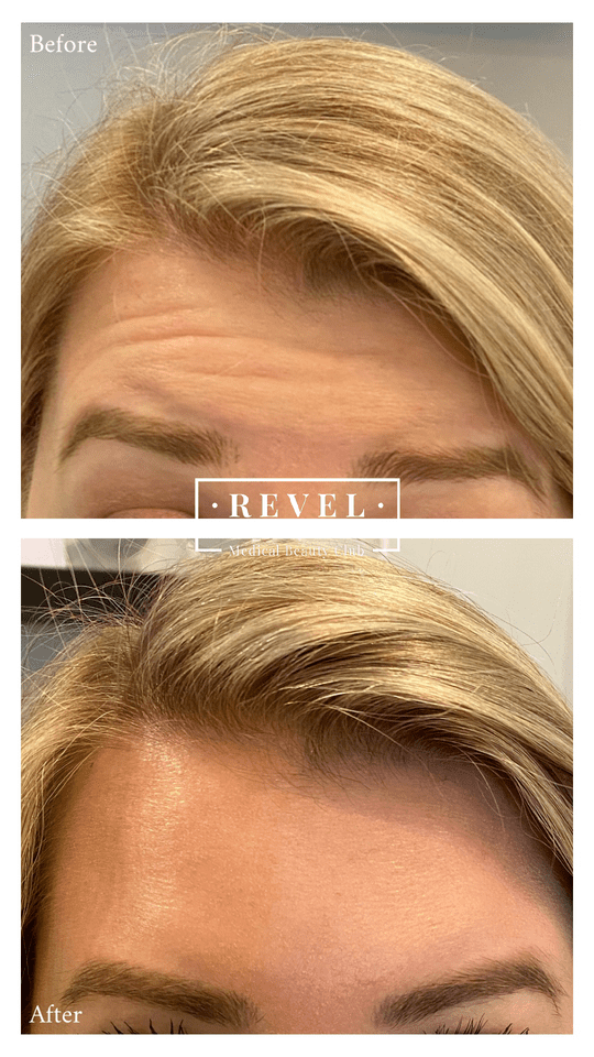 Smooth your brow with our highly effective wrinkle treatments.