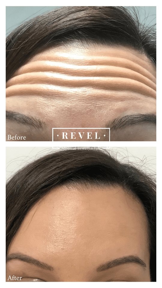 Our wrinkle treatments can banish forehead lines.
